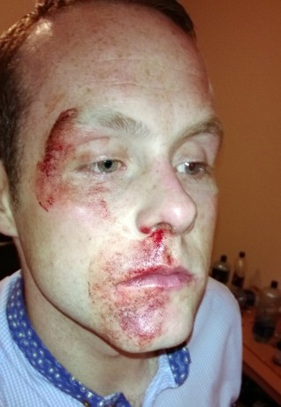 Dean McKenzie was viciously attacked in Belfast